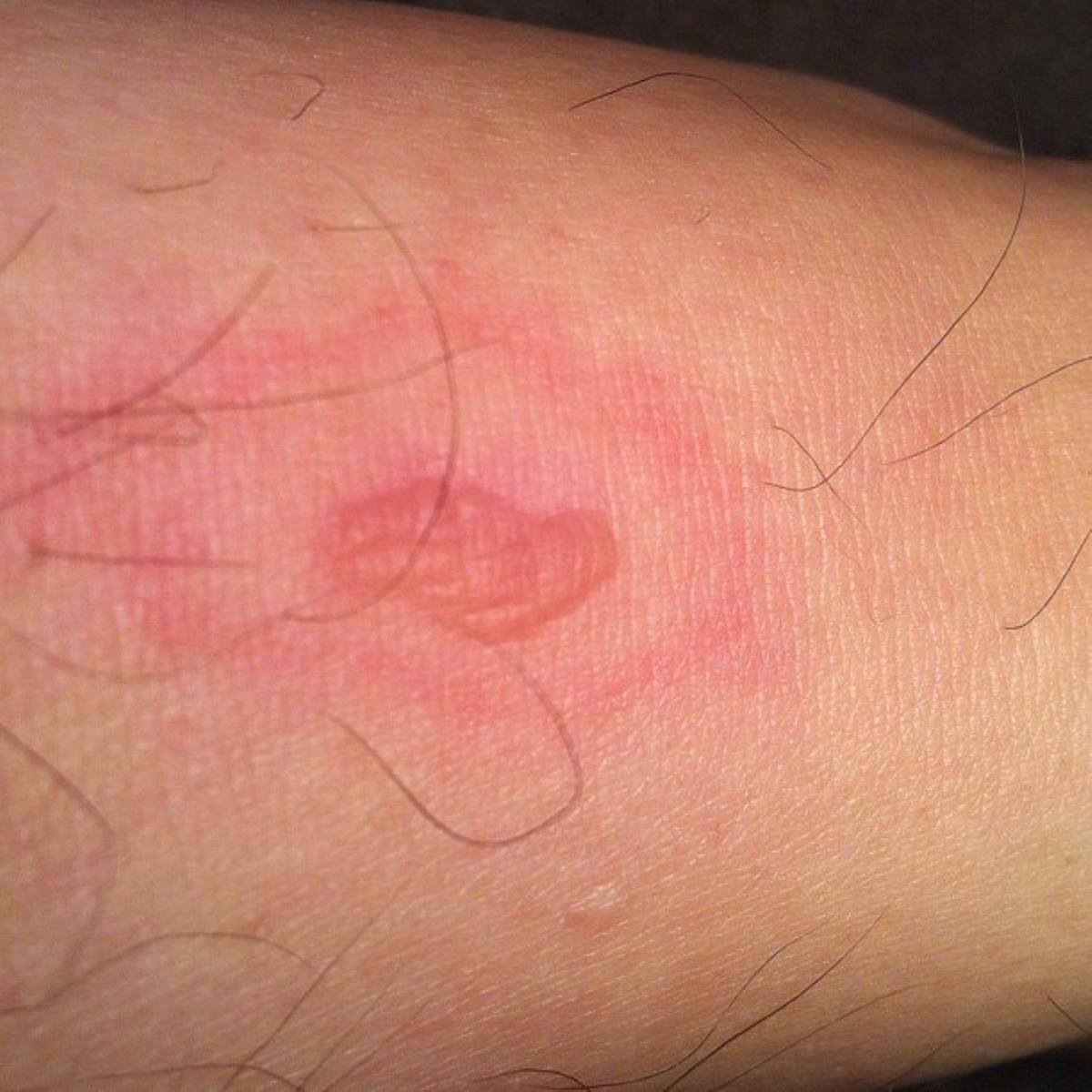 Morsure d'araignée violon.