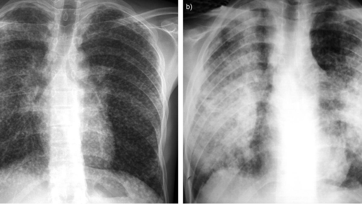 Pulmones con silicosis.