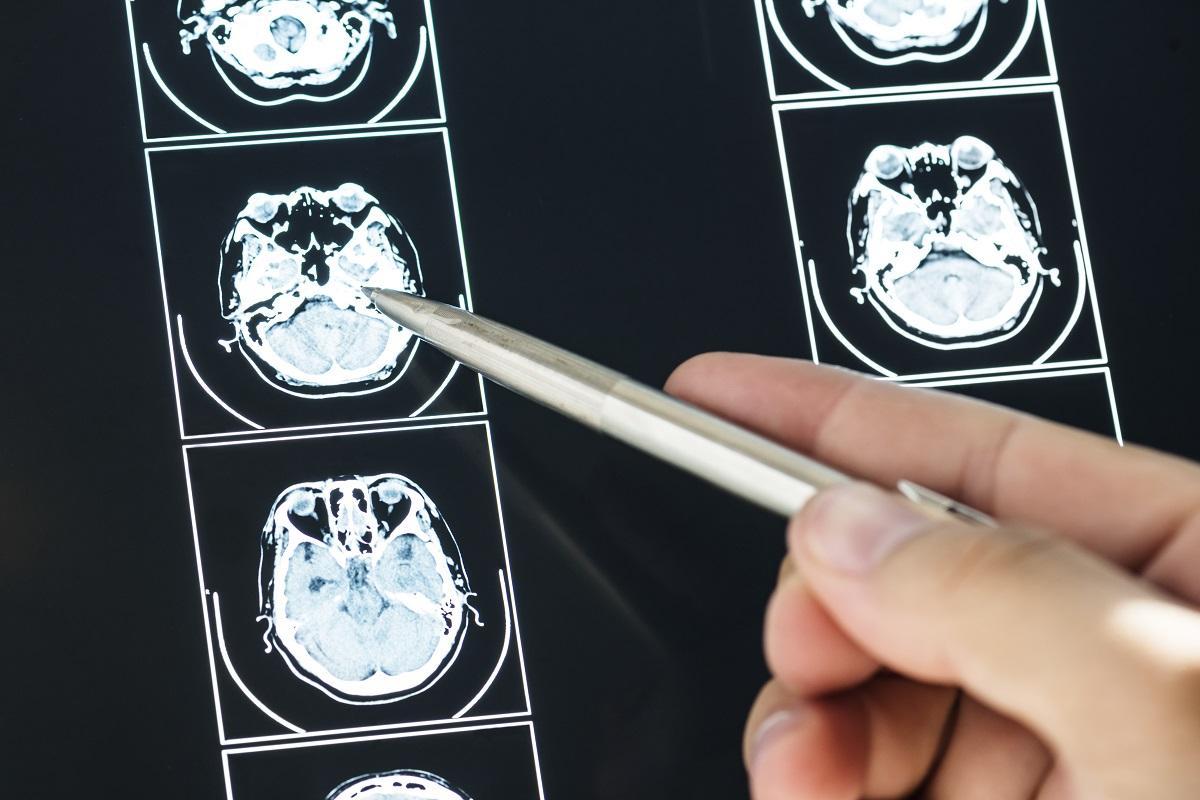 Les cas de sclérose en plaques au cours des 5 dernières années augmentent de 20%